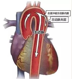 医师的专家团队认真讨论后一致认为患者是典型的主动脉夹层(stanford